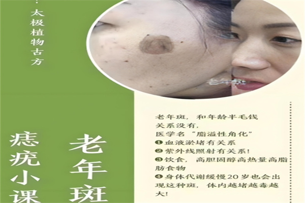 痣运星