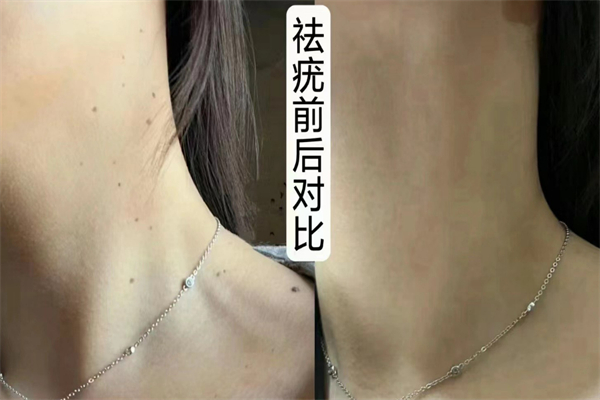 绣江南祛疣