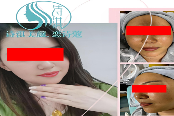诗淇美颜祛斑