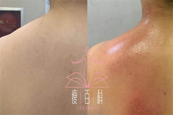 ​瘦百科减肥