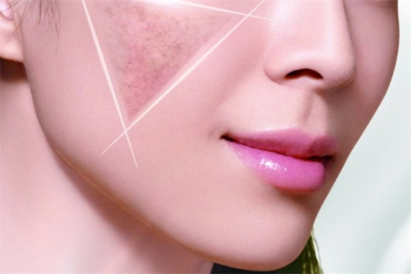 欧雅诗婷祛斑 欧雅诗婷祛斑