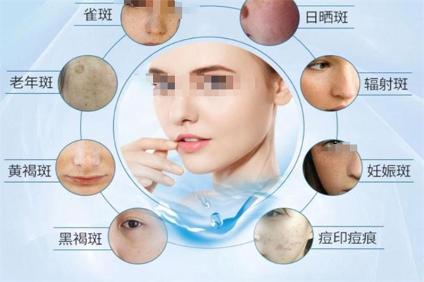 欧雅诗婷祛斑 欧雅诗婷祛斑