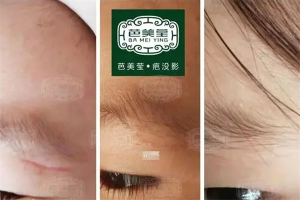 芭美莹疤痕修复