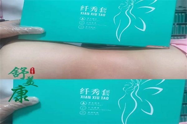舒美康减肥